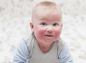 Атопический (аллергический) дерматит у ребенка